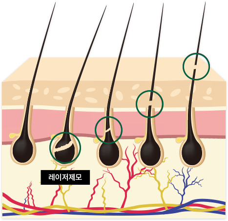 레이저 제모 모낭 이미지